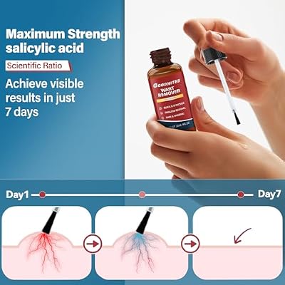 Goodwites Warts Remover - Maximum Strength Salicylic Acid